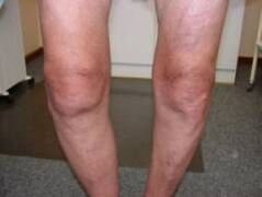 Síntomas de la artrosis de la articulación de la rodilla