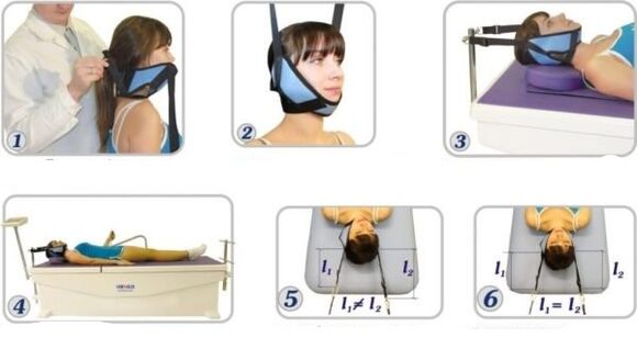 Tratamiento de la osteocondrosis cervical con eliminación