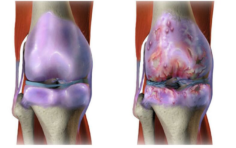 cartílago sano y destrucción de la articulación de la rodilla con artrosis