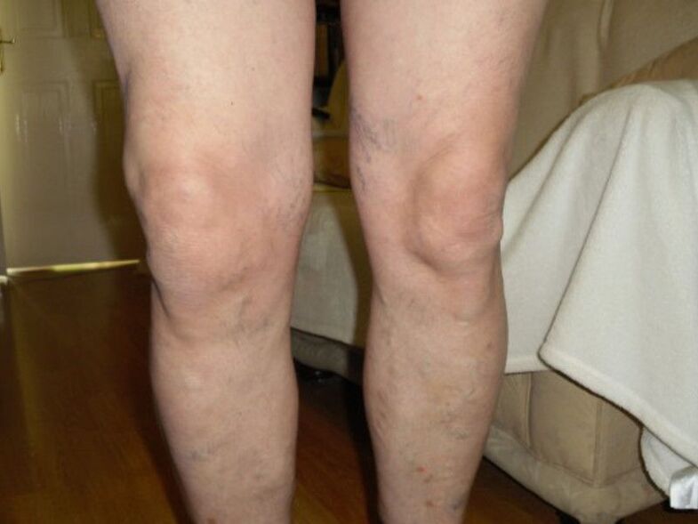rodilla sana y artrosis de la articulación de la rodilla