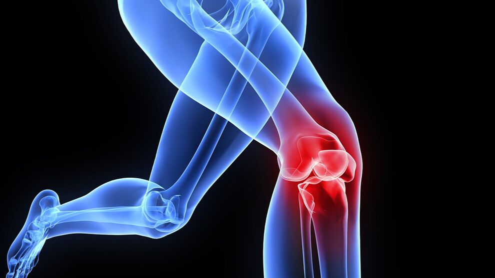 Problemas con las rodillas debido a la artrosis.