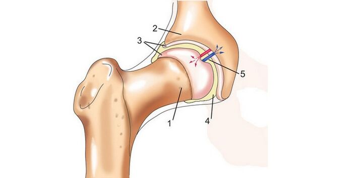 articulación de la cadera y artrosis