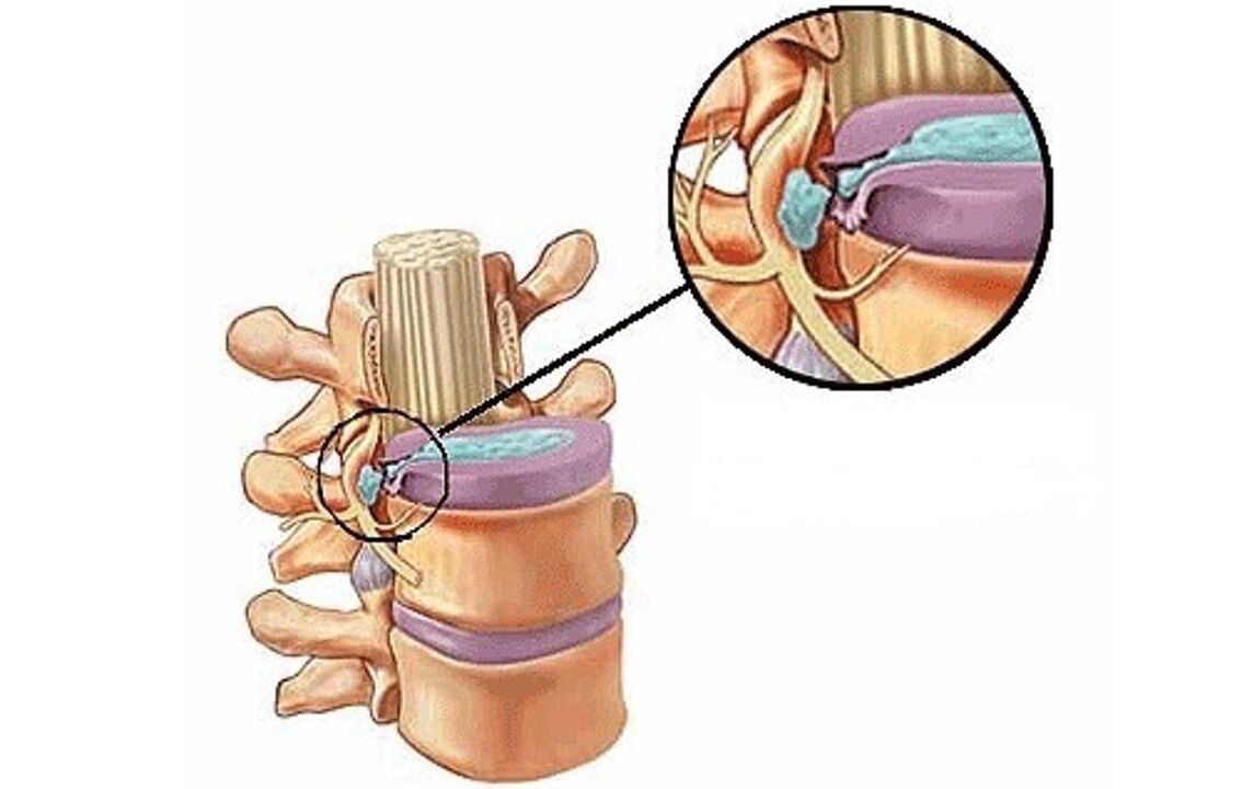 hernia intervertebral con osteocondrosis torácica