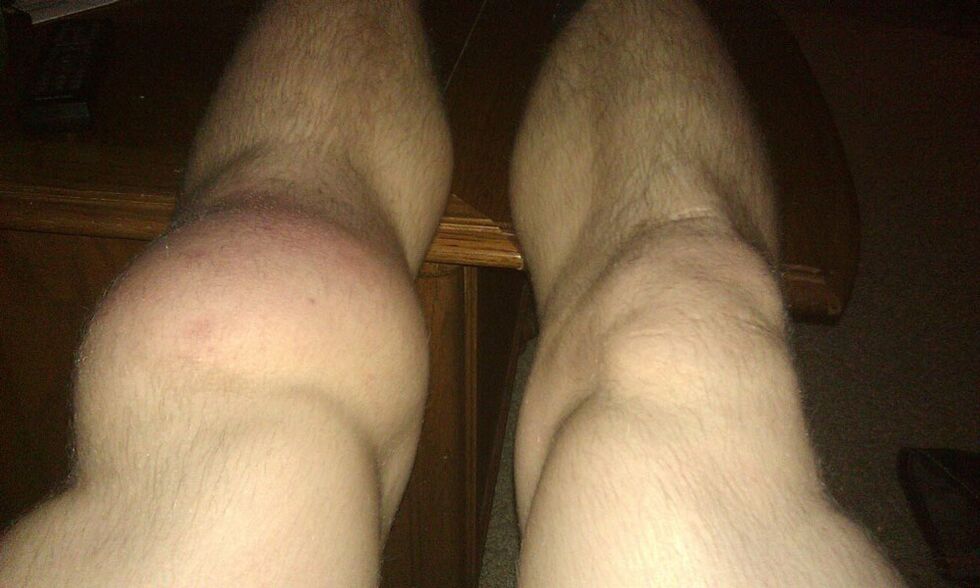 rodilla antes del tratamiento con Osteflex